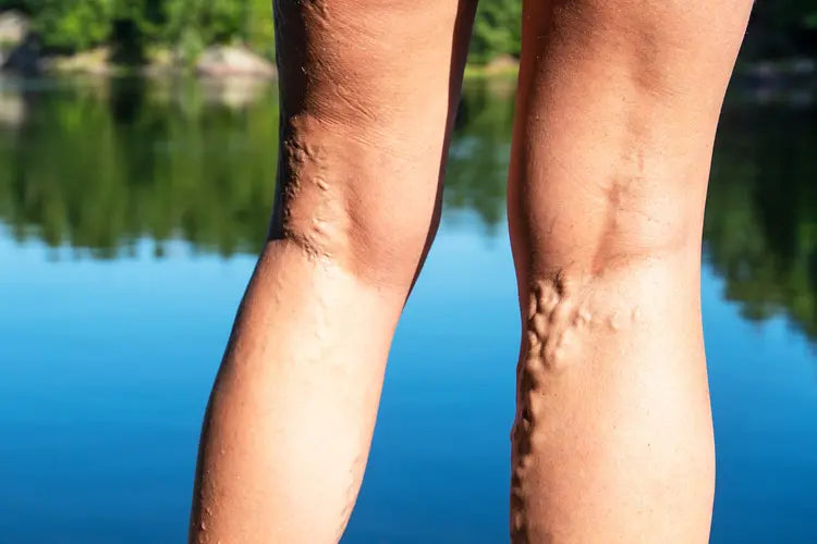 Varicose Veins
