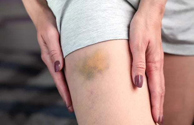 Bruises